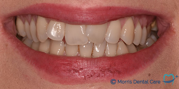 Before treatment the patient had worn teeth with some gapping